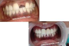 Dental-clinic-mallapur-nacharam