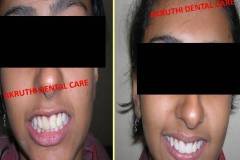 smile-designing-Akruthi-dental-care