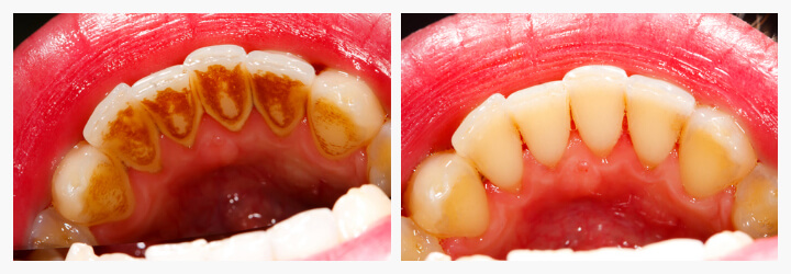 scale-and-polish-akruthi-dental-care